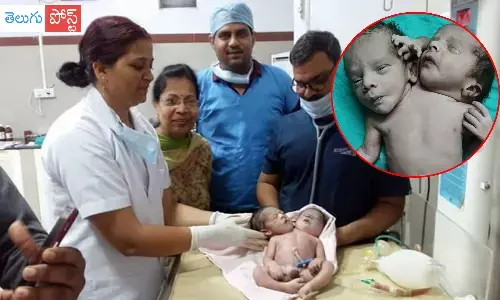 అరుదైన బిడ్డకు జన్మనిచ్చిన మహిళ.. రెండు తలల మధ్య నుంచి మూడో చేయి!