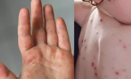 కేరళను వణికిస్తున్న టమోటో ఫీవర్.. లక్షణాలు, తీసుకోవలసిన జాగ్రత్తలివి !