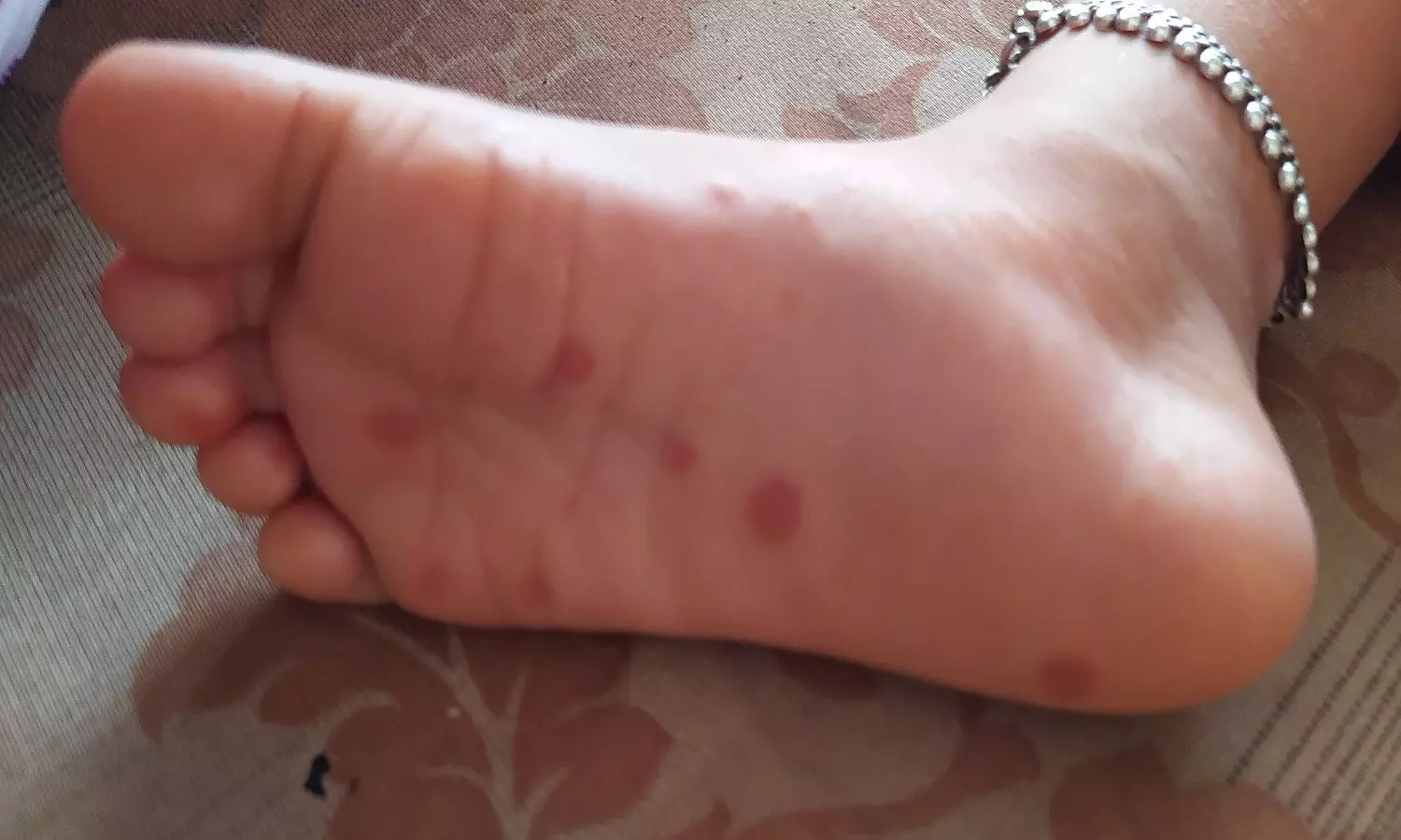 కేరళలో టమోటా ఫీవర్ కలకలం.. 80కి పైగా కేసులు