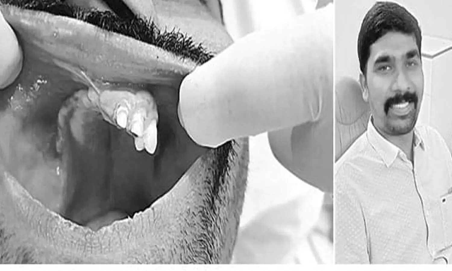 బ్లాక్ ఫంగస్ బాధితుడికి అరుదైన శస్త్రచికిత్స