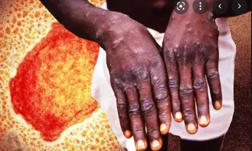 వణికిస్తున్న మంకీపాక్స్.. రోజురోజుకూ పెరుగుతున్న కేసులు