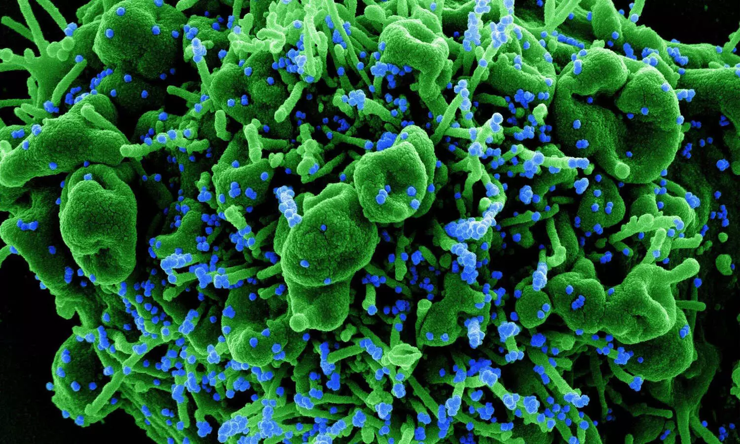 corona virus, positive cases, deaths, recovery, telangana