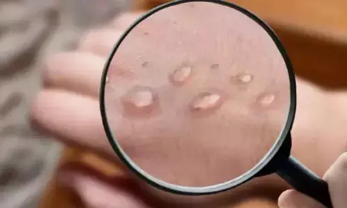 child, monkeypox, vijayawada