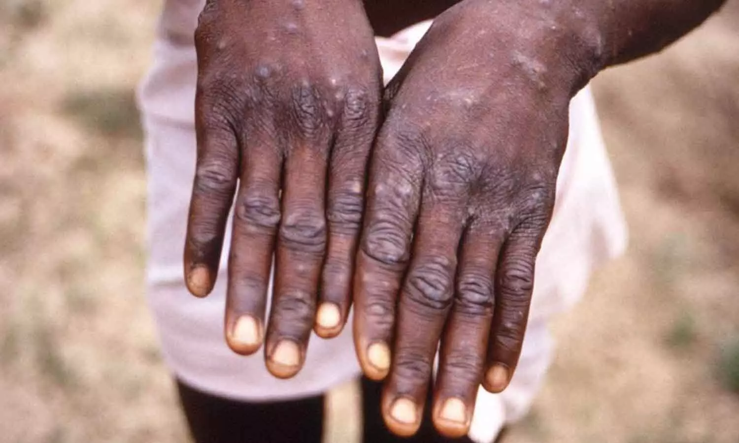 monkeypox, second case, kerala