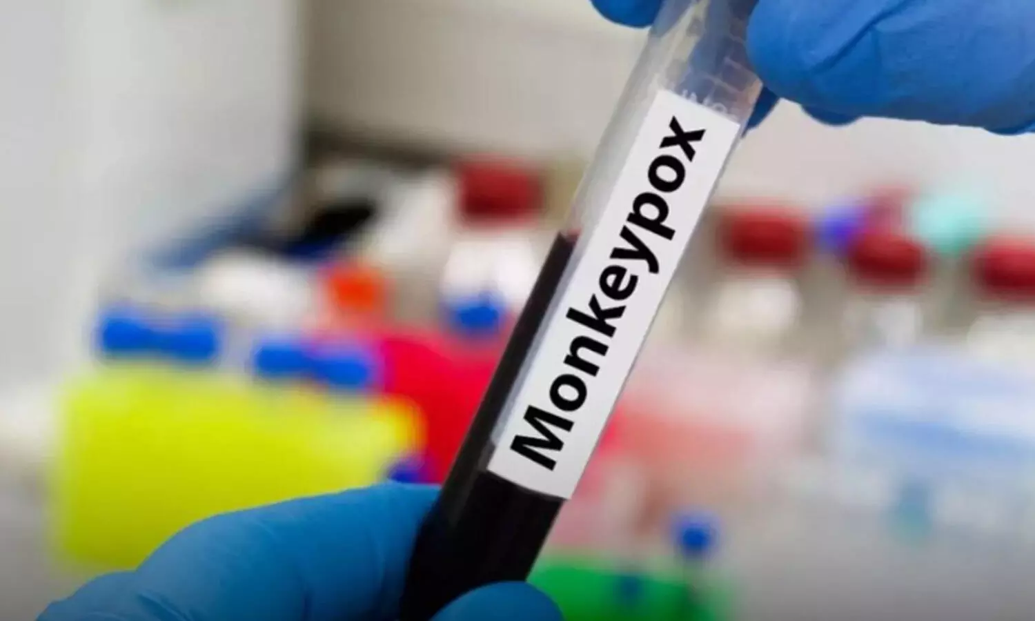తెలంగాణలో మంకీపాక్స్ కేసు?