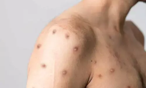 బ్రేకింగ్ : కేరళలో ఐదో మంకీ పాక్స్ కేసు నమోదు