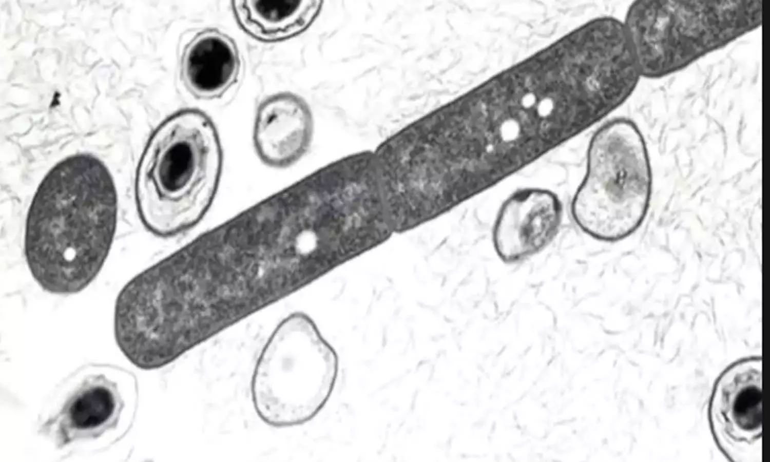 అల్లూరి జిల్లాలో అంత్రాక్స్.. వణుకుతున్న గిరిజనులు