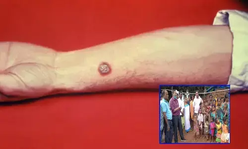 విశాఖలో ఆంత్రాక్స్ అలజడి.. 40 మందికి సోకిన వ్యాధి