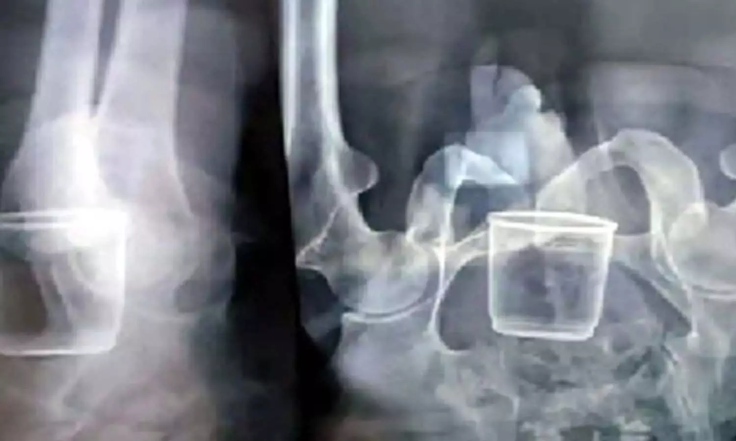 ఆశ్చర్యం...వృద్ధుడి పొట్టలో గ్లాసు