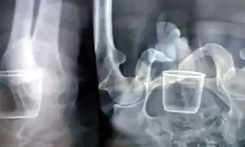 ఆశ్చర్యం...వృద్ధుడి పొట్టలో గ్లాసు