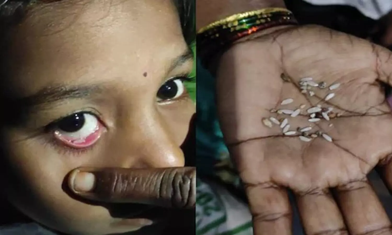 stones and gain of rice from girls eye, jogulamba gadwal district