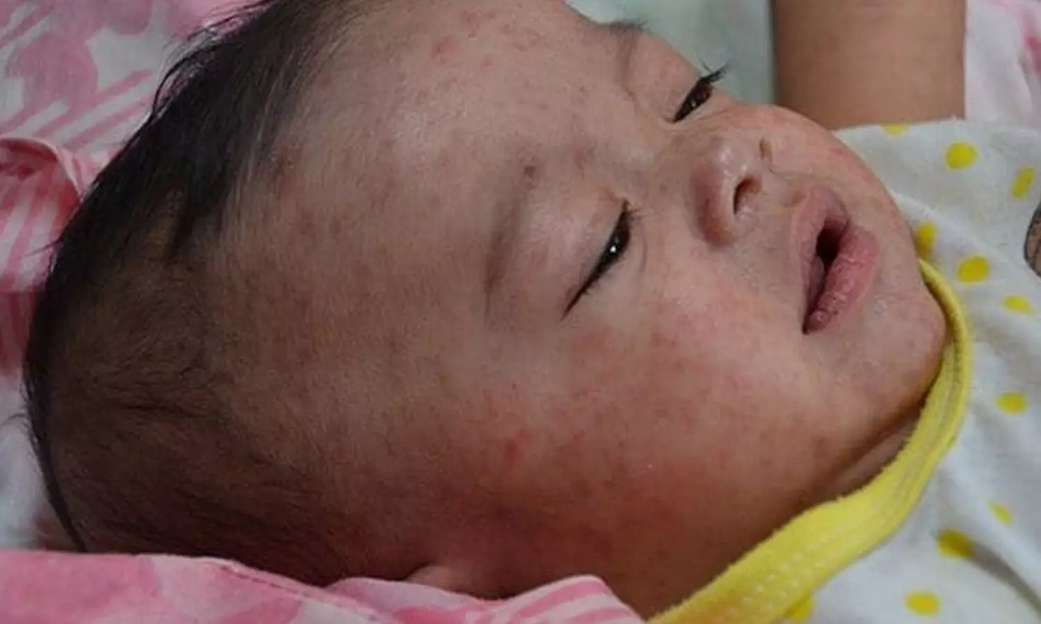 measles outbreak in mumbai, 13 children died with measles
