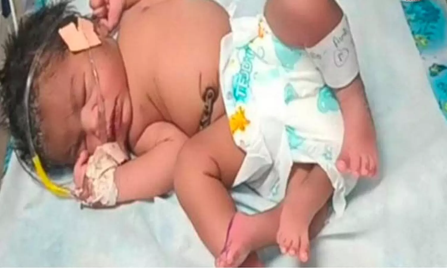 4 legs baby, why baby born with 4 legs