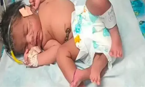 4 legs baby, why baby born with 4 legs