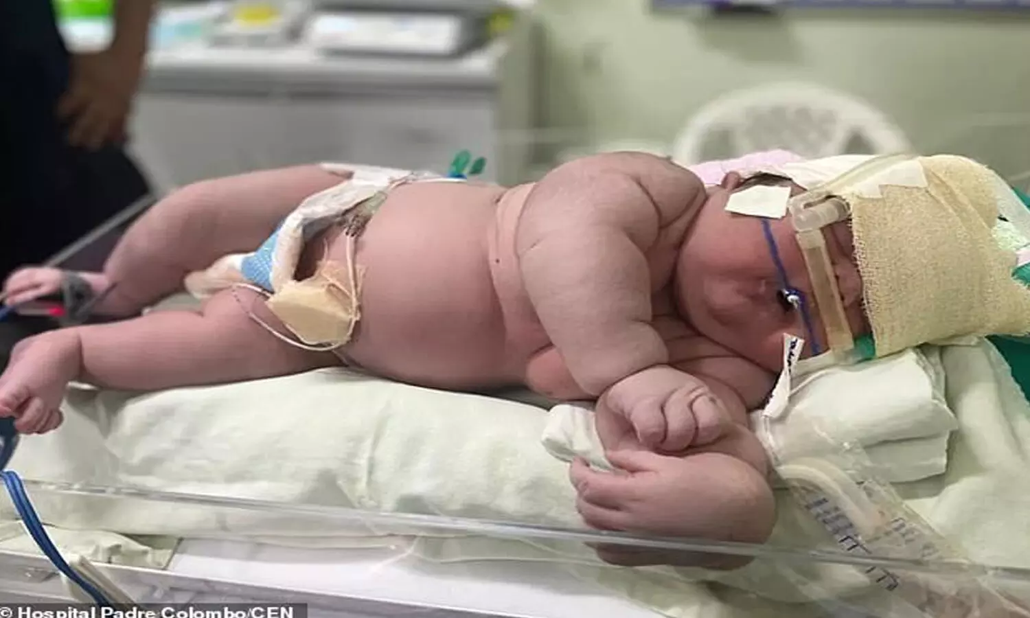 a giant baby, two feet baby, baby born in brazil