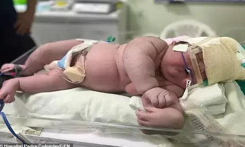 a giant baby, two feet baby, baby born in brazil