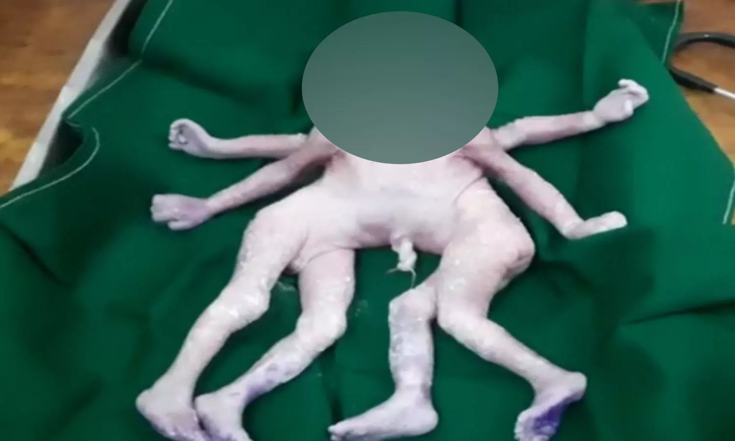 రెండు గుండెలు, నాలుగు కాళ్లు, నాలుగు చేతులతో శిశువు జననం