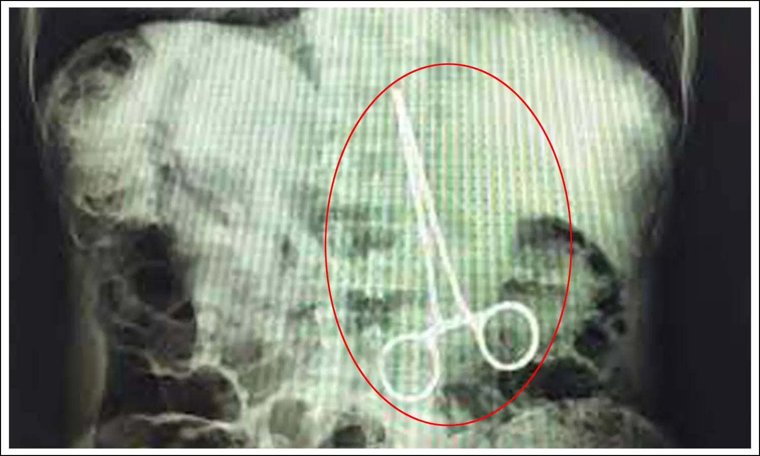 డెలివరీకి వచ్చిన మహిళకు ఆపరేషన్‌.. కడుపులో కత్తెర వదిలేసిన వైద్యులు