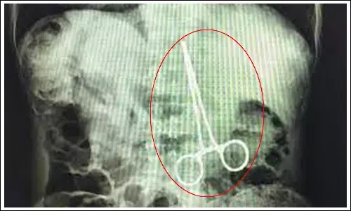 డెలివరీకి వచ్చిన మహిళకు ఆపరేషన్‌.. కడుపులో కత్తెర వదిలేసిన వైద్యులు