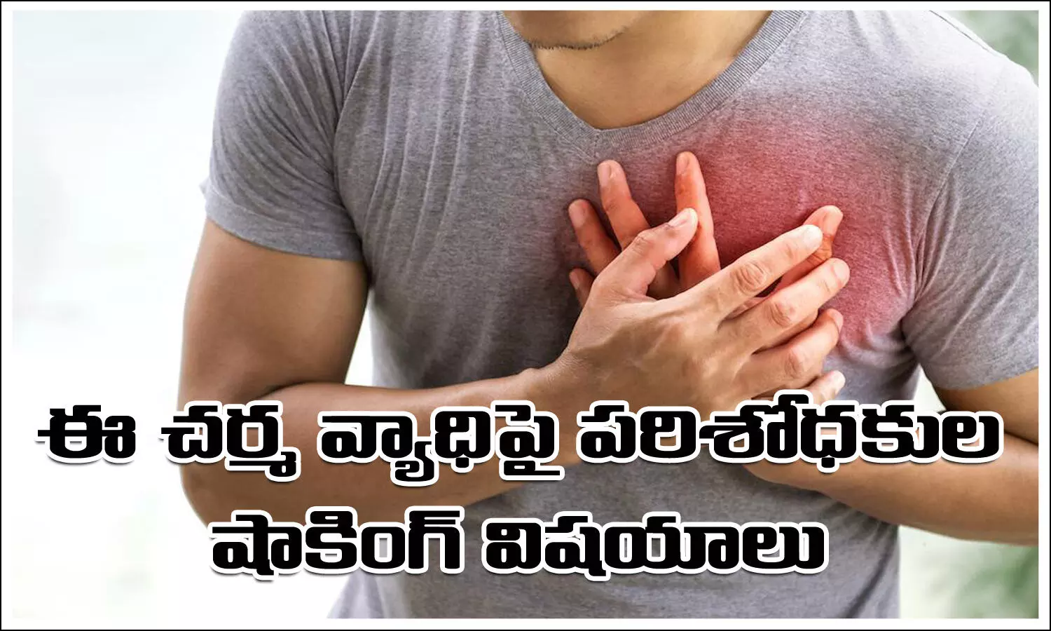 Heart Disease, Severe Psoriasis, Researchers