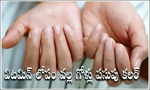 Yellow nails, Nails, Health Problems, Nails Tips, vitamin deficiency causes yellow nails