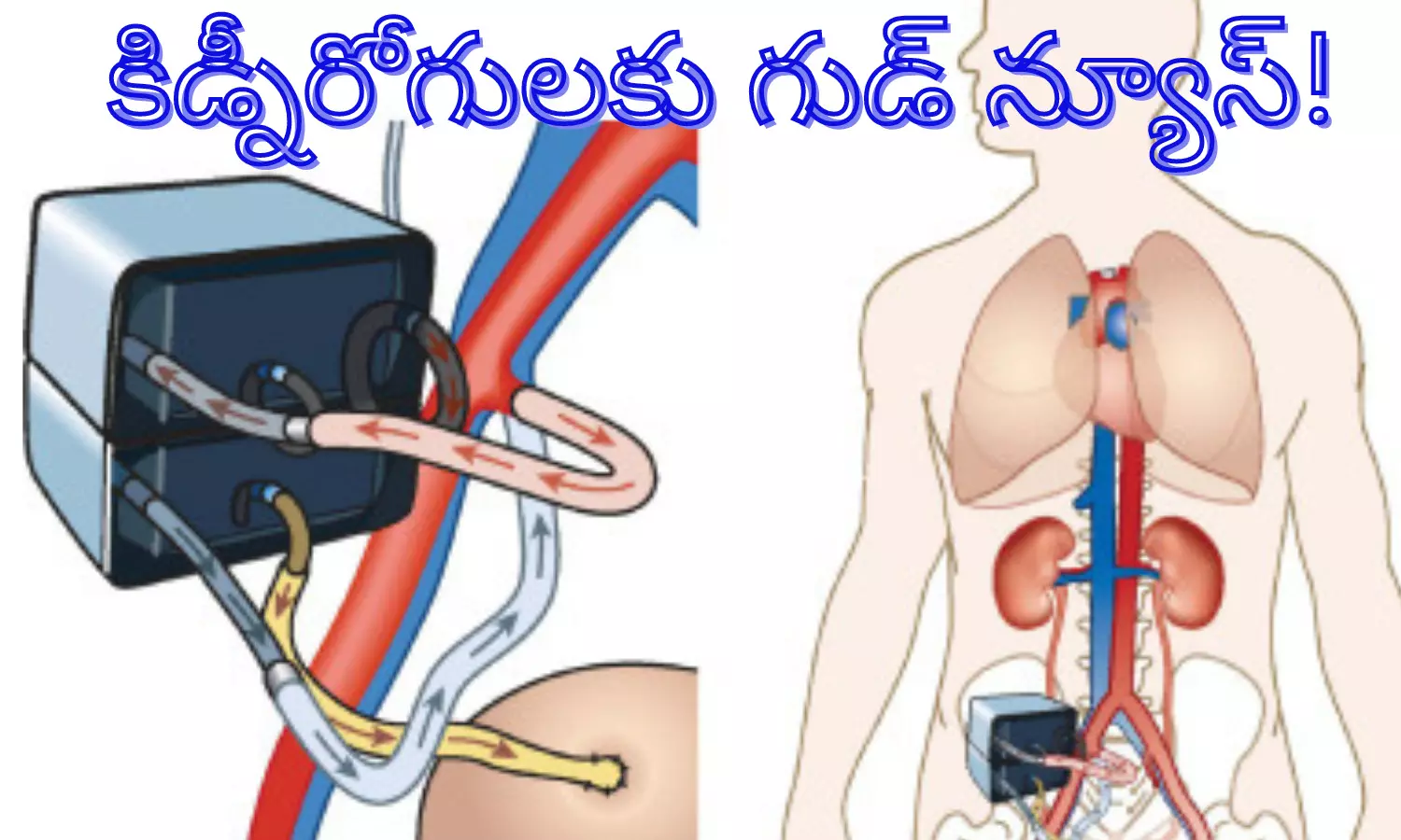 కిడ్నీరోగులకు గుడ్ న్యూస్!
