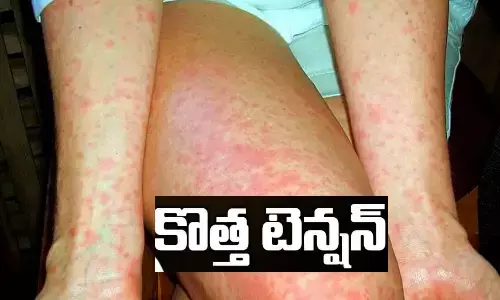 hyderabad, Health, Paediatricians, ScarletFever, ScarletFeverSymptoms, symptoms