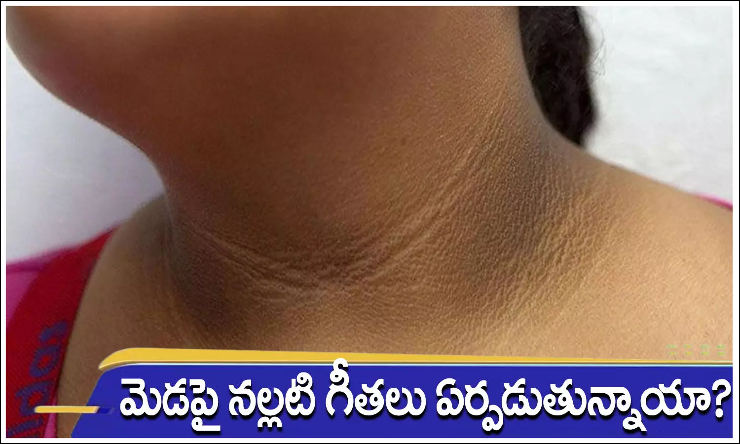 Dark lines on neck, Dark lines on neck, Symptom, Acanthosis Nigricans