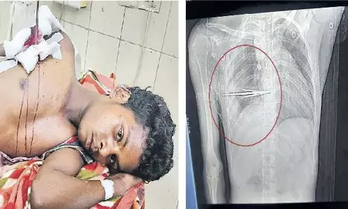 ఆదివాసీ యువకుడి ప్రాణాలను కాపాడిన నిమ్స్ వైద్యులు