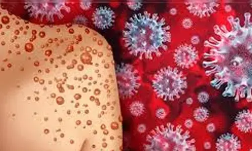 monkeypox, registered, dubai, karnataka