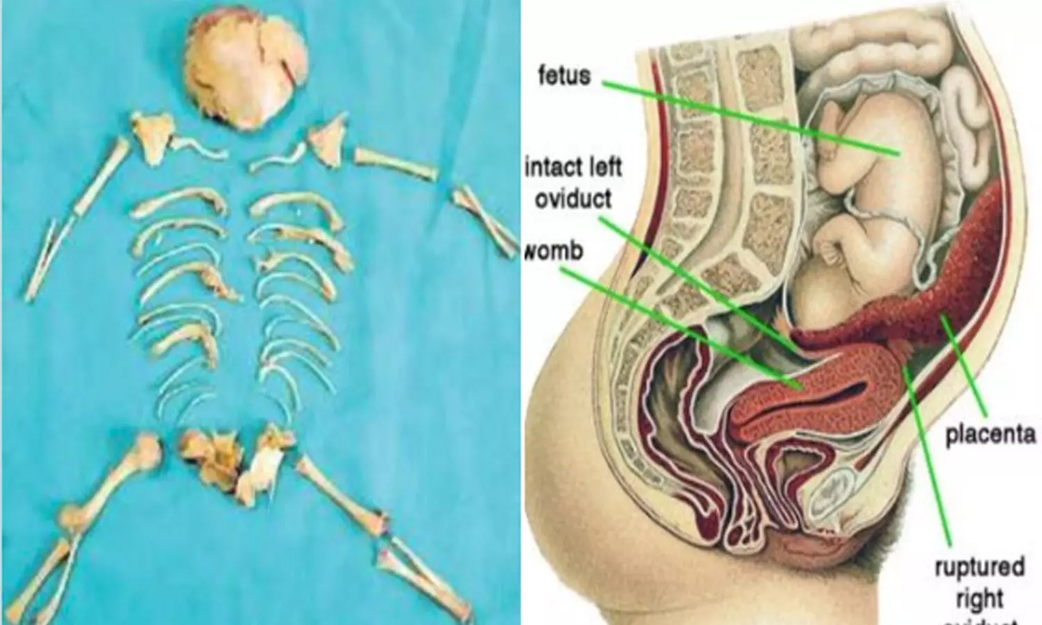 lithopedion, rare operation, king george hospital,  visakhapatnam