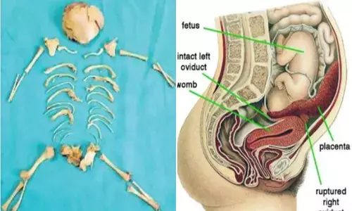 lithopedion, rare operation, king george hospital,  visakhapatnam