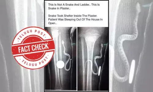Snake sneaks into plaster cast, live snake seen in X-ray, X-ray showing snake inside a plaster cast,   snake inside a plaster cast on a fractured leg,   viral image of an X-ray showing snake