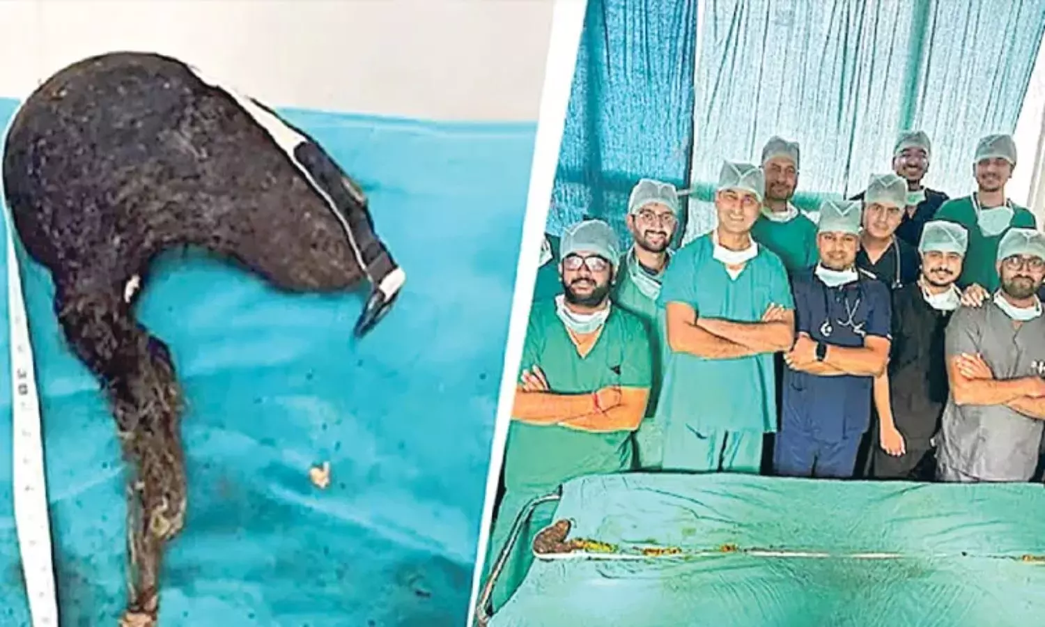 బాలిక పొట్టలో 2 మీటర్ల వెంట్రుకల పోగు.. తీయడానికి శ్రమించిన వైద్యులు