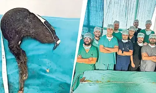 బాలిక పొట్టలో 2 మీటర్ల వెంట్రుకల పోగు.. తీయడానికి శ్రమించిన వైద్యులు