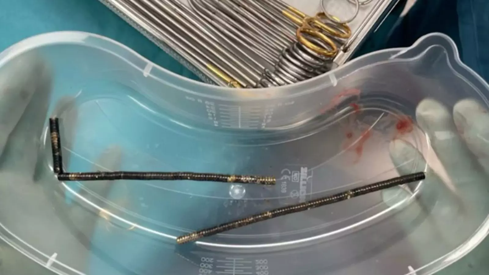 బాలుడి కడుపులో 100 అయస్కాంతాలు!