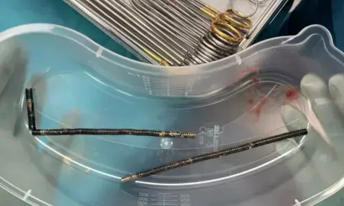 బాలుడి కడుపులో 100 అయస్కాంతాలు!