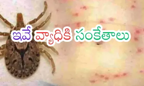 Andhra Pradesh : ఆంధ్రప్రదేశ్ ను వణికిస్తున్న స్క్రబ్ టైఫస్ వ్యాధి
