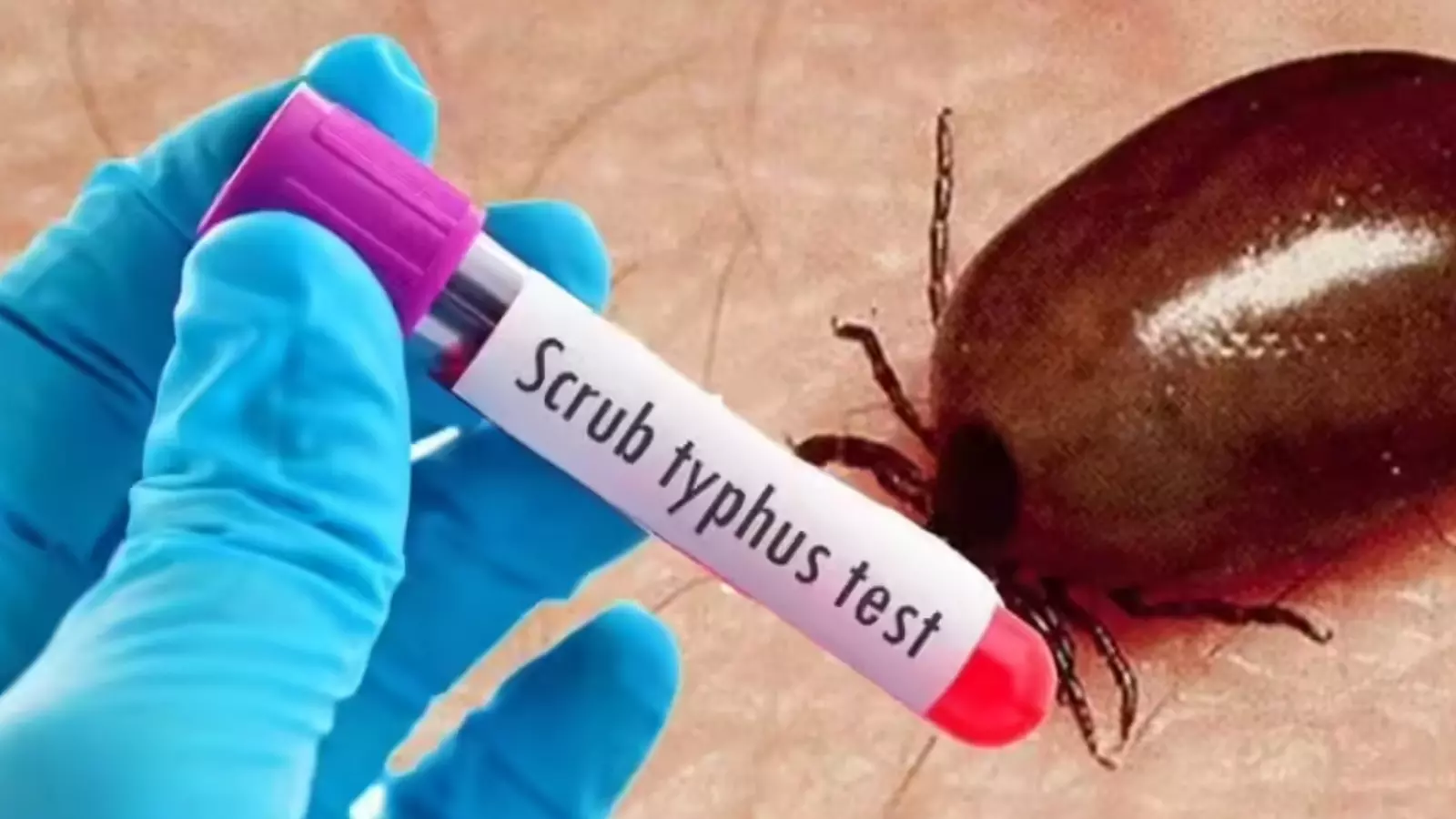 Andhra Pradesh : ఏపీలో పెరుగుతున్న స్క్రబ్ టైఫస్ కేసులు