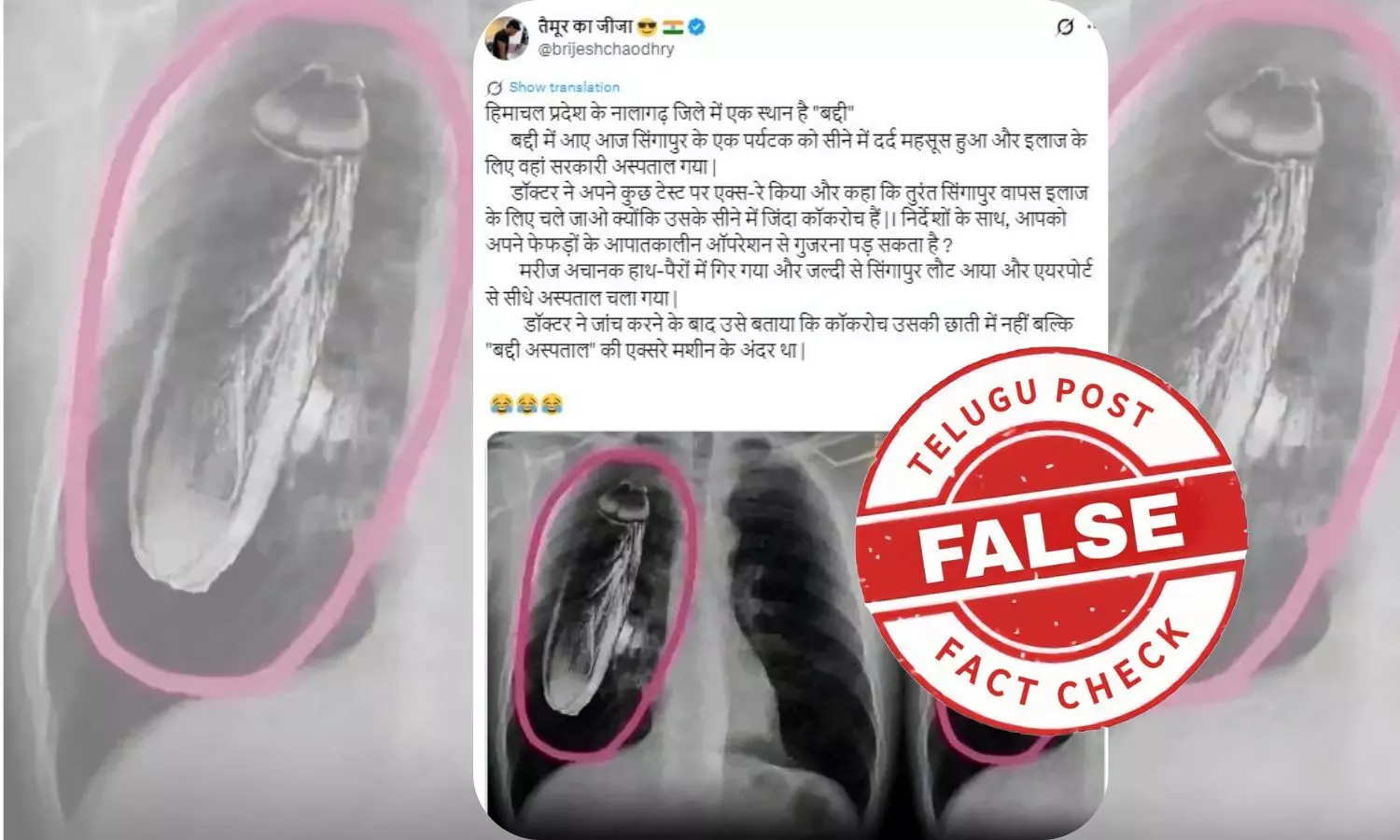 Cockroach in X-ray, Solan Regional Hospital, Singapore tourist, Normal chest X-ray, Dr Frank Gaillard Cockroach in X-ray, Solan Regional Hospital, Singapore tourist, Normal chest X-ray, Dr Frank Gaillard